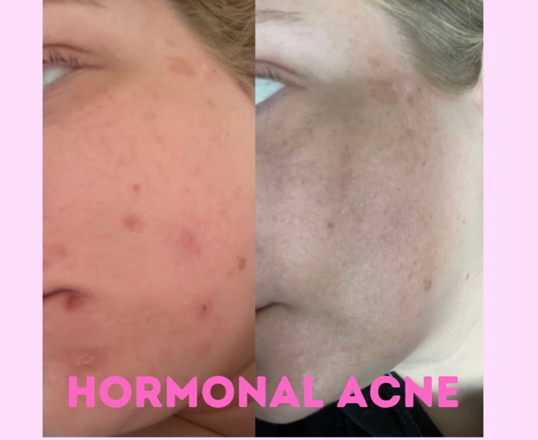 Katie skin improvement before and after